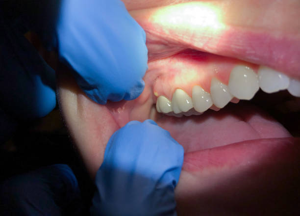 Best Dentist for Tooth Abscess  in Frostproof, FL